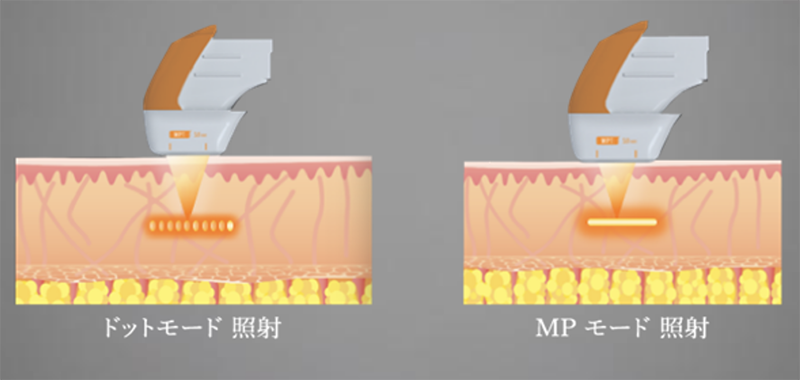 ウルトラフォーマーⅢ／ハイフシャワー｜京都の山本クリニック ソフト