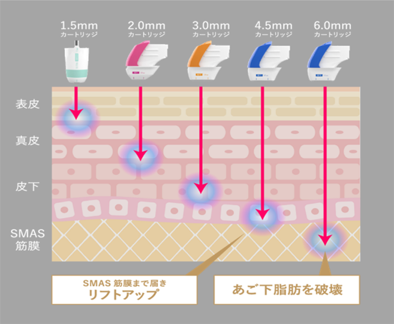 ウルトラフォーマーⅢ／ハイフシャワー｜京都の山本クリニック ソフト